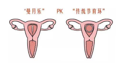 放置曼月乐和放置普通宫内节育环的对比图.jpg