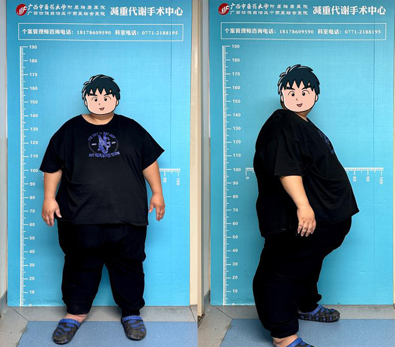 2术前胖友身体正侧站位.jpg