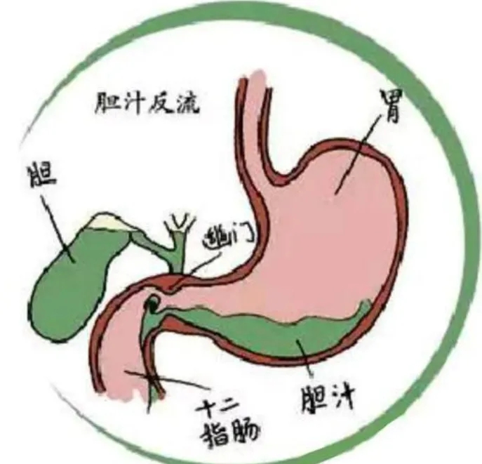 吃了一堆胃药没用，原来是胆汁在 “倒戈”